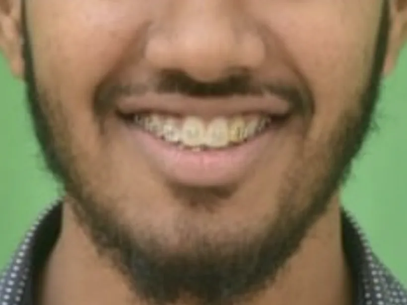 The same smile during treatment, with braces aligning the upper front teeth