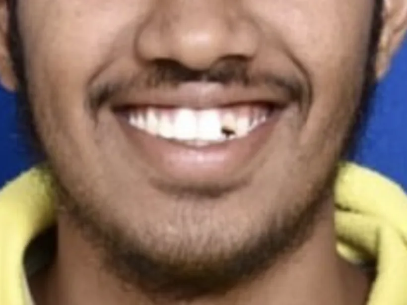 Smile before treatment, with an upper front tooth out of line