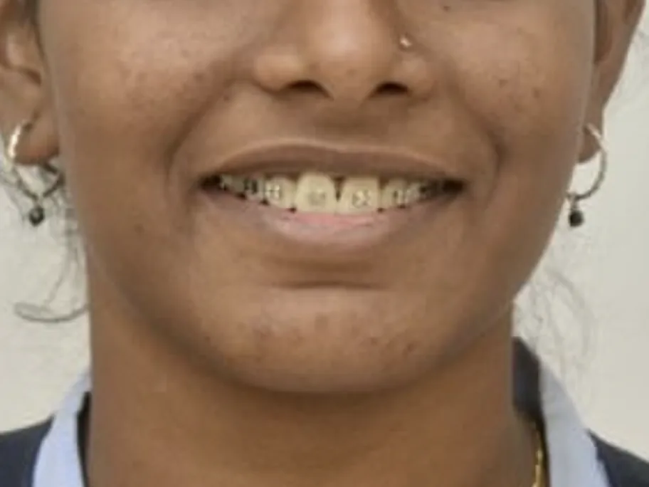The same smile during treatment, with braces on the upper and lower teeth