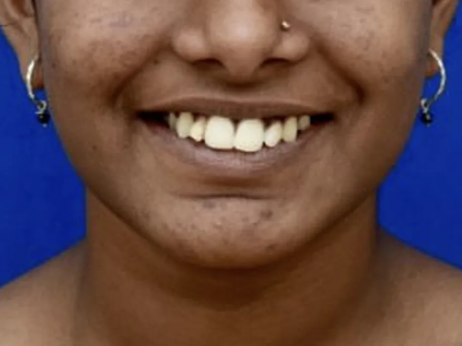 Smile before orthodontic treatment