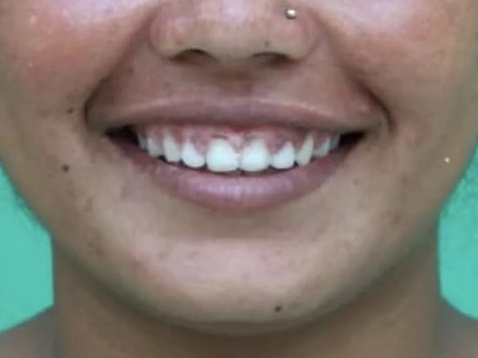 The same smile after braces, with the gaps between the upper front teeth closed