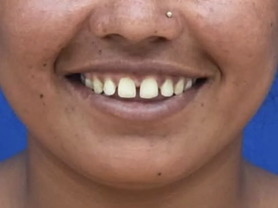 Smile before treatment, with visible gaps between the upper front teeth